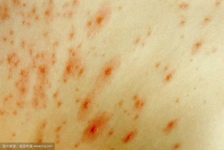 旺仔国际幼儿园 蒙氏跨越班 预防水痘之从我做起