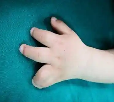 孩子并指畸形,从中间"劈开"就行了?