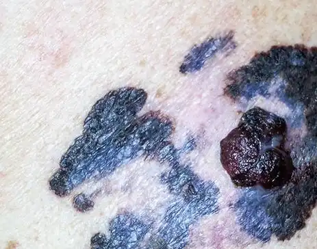 28岁姑娘点了颗痣,竟发生癌变……痣出现这4种特征癌变可能性大_方法