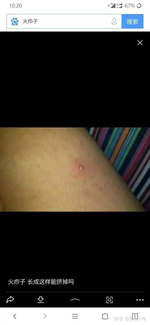 我感觉这东西就是个普通疙瘩发炎了!这是第一次!