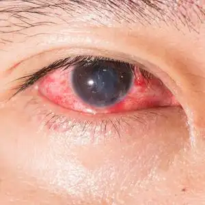 眼睛考试眼睛考试眼睛检查聪明的重点的子命名字母子在眼试验结膜出血