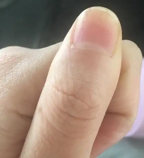 指甲凹凸不平,慢慢变黄变厚,现在大拇指甲里还长了黑线,一年多了