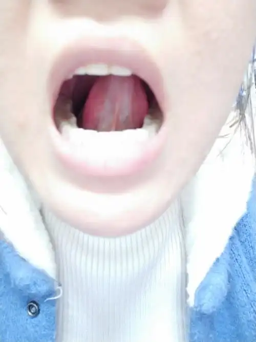 舌下络脉淤血20%