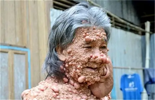 肿瘤专家_治疗肿瘤哪个专家好_治疗肿瘤最好的专家/排行_有来医生