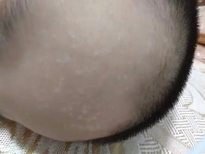 五岁宝宝额头长了许多小白点是怎么回事不庝也不痒