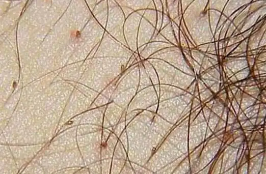 "阴虱"是什么?为啥患者都是女性?