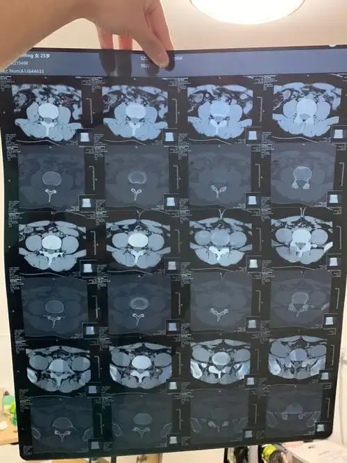 就去拍了腰椎ct,医生说腰没有问题,开点药让我回去锻炼腰背肌.