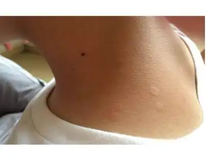 汗斑图片大全51