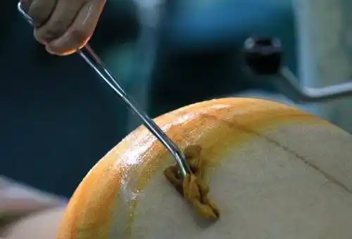 剖宫产同样也会"备皮"而且还要剔除腹部的毛发,为手术做好准备.