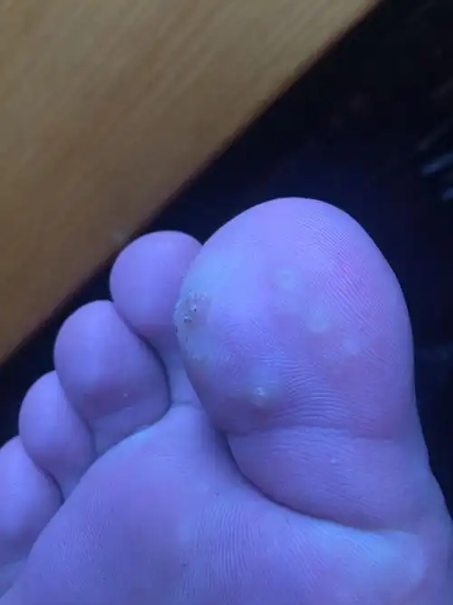 我的脚又容易产生汗,可能是某种细菌感染了,请问,有谁知道具体是什么