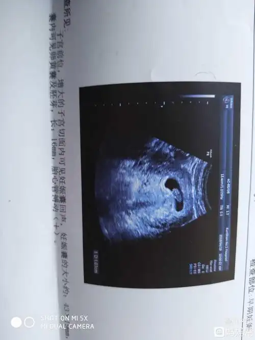 孕囊大小看男女的方法 1孕囊大小看胎儿性别 有传言说,如果孕囊大小的