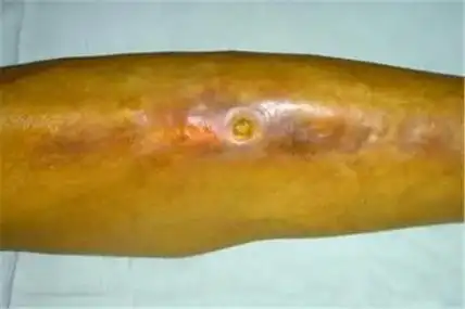 骨髓炎的症状是什么呢