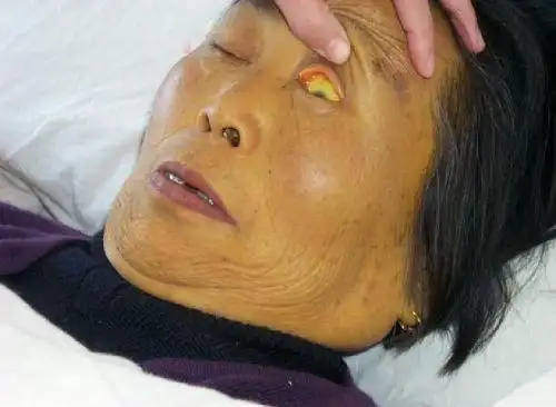 27岁女子新婚不久确诊肝癌2个月后离世丈夫面部早给提醒