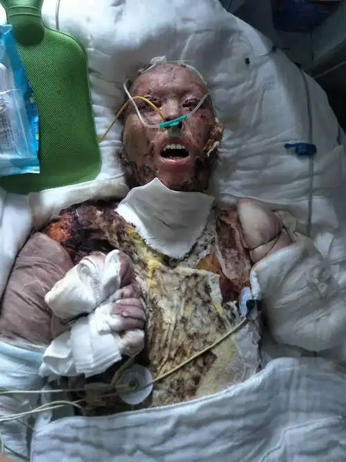 救人英雄郭朋朋特大烧伤近十个月无人过问拷问县委书记黄巍领导责任