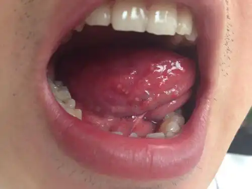 舌头两侧都是这样的泡疹?怎么治吃什么药?