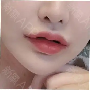 m唇手术好不好_效果图_是你的汐汐m唇手术术后第46天_新氧美容整形