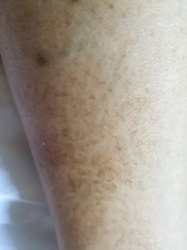 小腿出现斑纹 - 皮肤与性传播疾病讨论版 -丁香园论坛