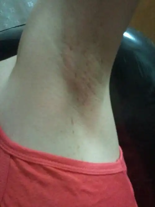 请问这是汗斑吗?它长在腋下,几年了,不痛不痒,但是好像有慢慢增多.