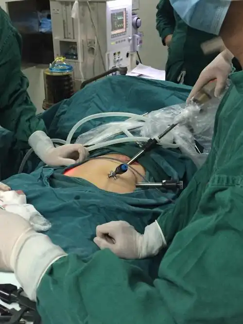 腔镜阑尾切除术