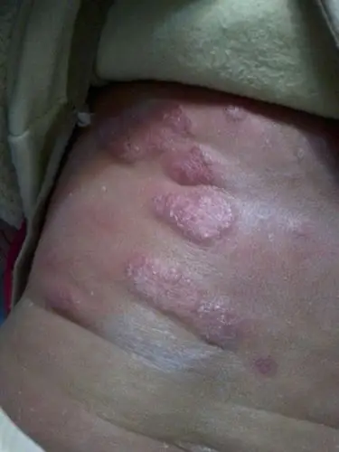 四个月大的宝宝后背出现的,去了医院医生说是湿疹,想请问一下如何快速