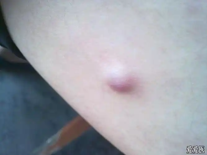 8cm)二个月,无搔痒无痛,质韧,不知是否是纤维瘤?有必要做什么检查?