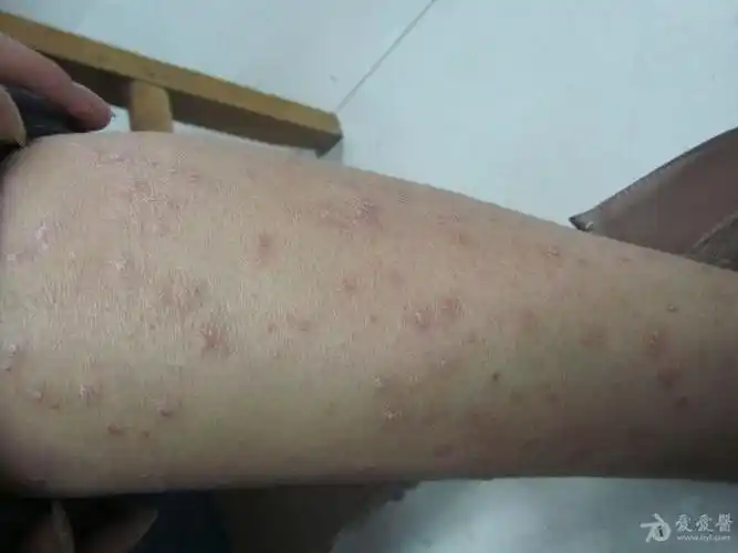 女士身上的丘疹——寻常性银屑病 - 皮肤及性传播疾病讨论版 - 爱爱医