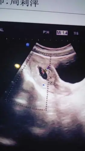 椭圆形或者圆形为女孩统计资料显示,b超下常见的孕囊形态多为圆形或