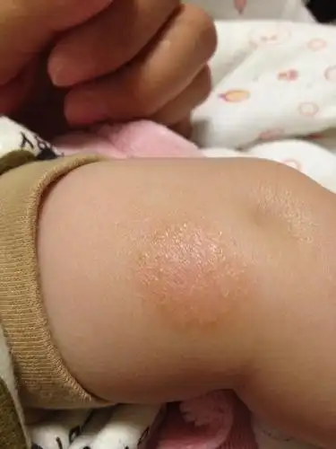我家宝宝五个月,最近发现胳膊上长一块硬币发现的癣,这是怎么回事?
