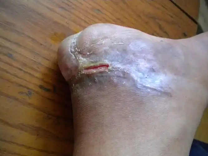 伤口长期不收求教