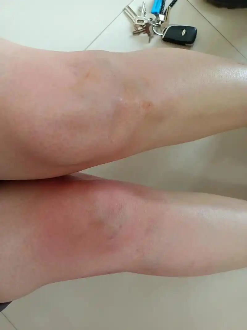 一个多月前膝盖疼,做的磁共振,只说缺少润滑液,有积液,开了几 - 抖音