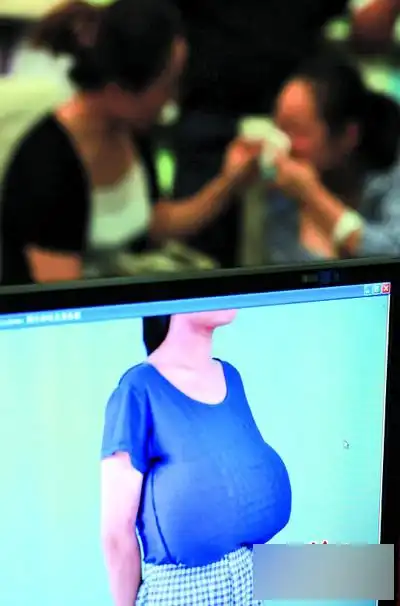 13岁女学生乳房大如篮球 重量是正常人20倍