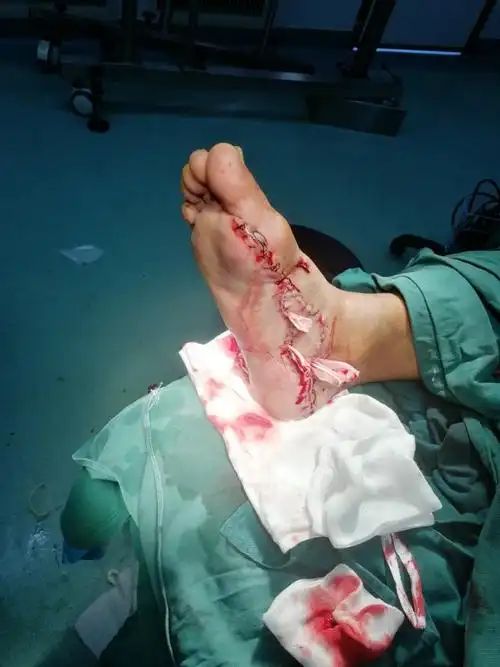 患者的脚底成功缝合.