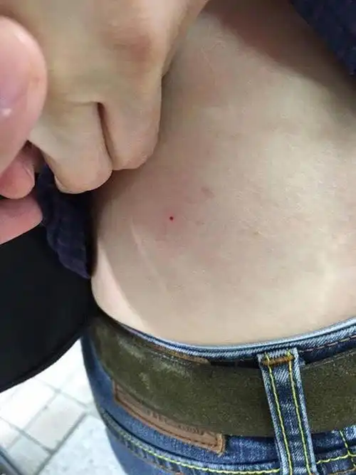 图为受害人背后被注射器扎出大针孔.