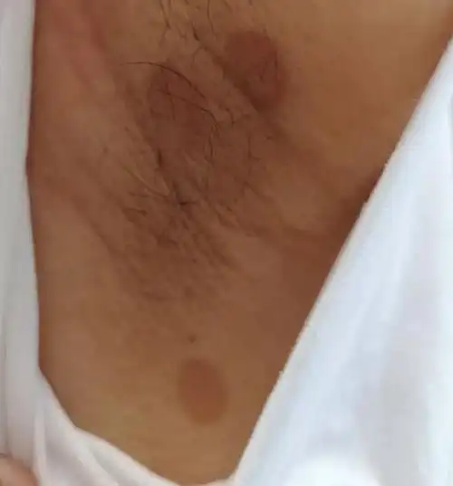 汗斑,花斑癣,花斑糠疹的故事