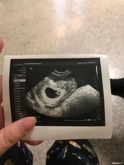 [试管婴儿]今天又做了阴超,算是一超的加强版?