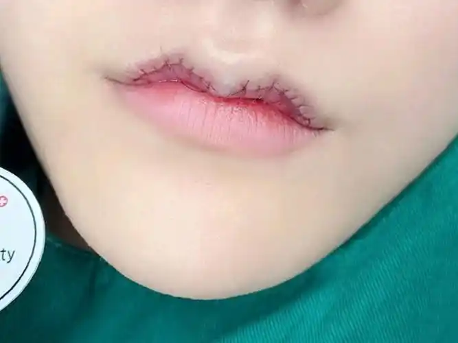 刚做的m唇,我感觉术后效果还是很美观的,之前上_圈子-新氧美容整形