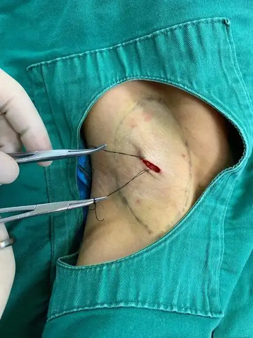 打针法:以肉毒毒素注射腋下,使大汗腺萎缩,抑制汗腺的分泌.