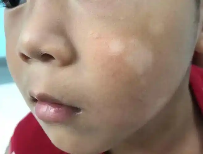 (现代医学称为白色糠疹,蛔虫感染会有此斑,但出现此斑不代表一定是有