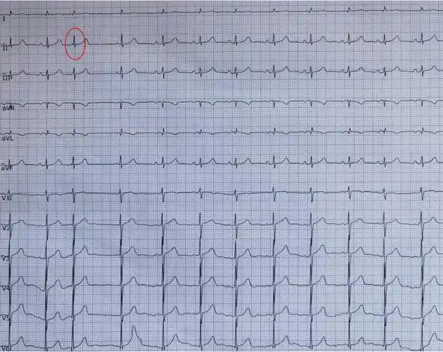 心房下部的房性早搏,p 波的形态与窦性明显不同,呈逆行 p 波,与交界