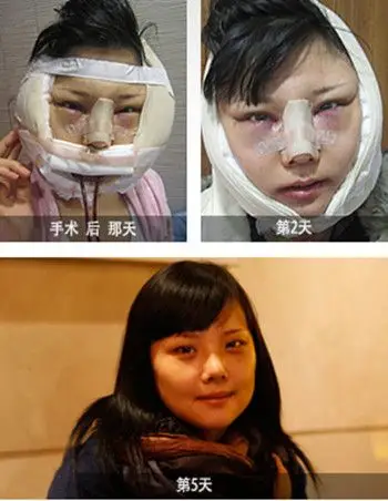 韩国博朗温全脸整形六个月全记录