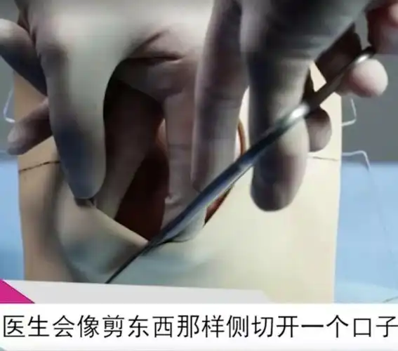 孩子生出来之后,迅速缝合伤口.