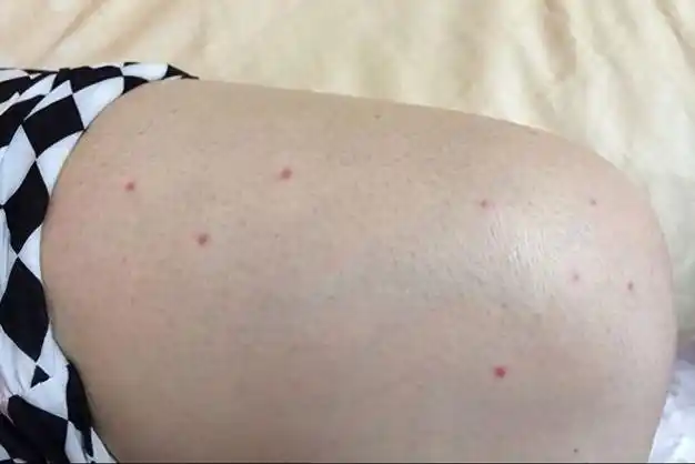 医生提醒:身上突然出现小红点,别不当回事,或是肝癌来临的信号