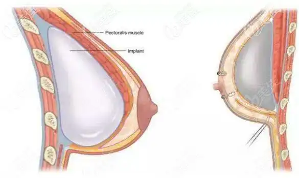 假体隆胸的位置