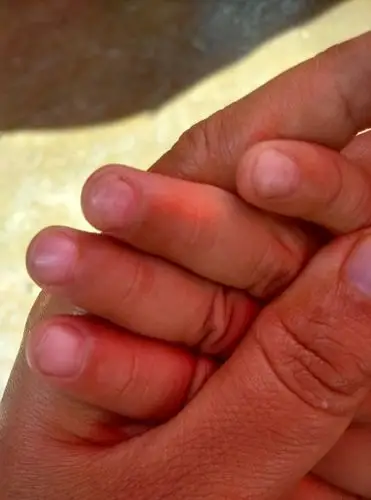 是不是灰指甲呀,有没有人知道,去医院检查说是缺锌