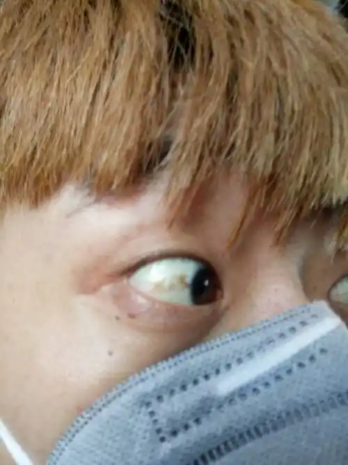 白眼球上有黄斑,而且很明显变大了.稍微感觉有点凸起的感觉.怎么回