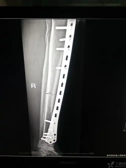 右胫骨开放性骨折一例 [病例帖]