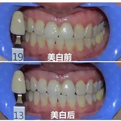 牙齿美白前后对比