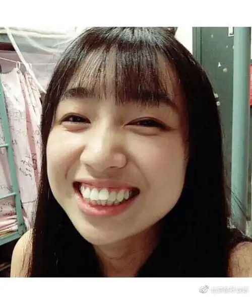 3个月龅牙内收明显太后海没有早点矫正北京龅牙矫正