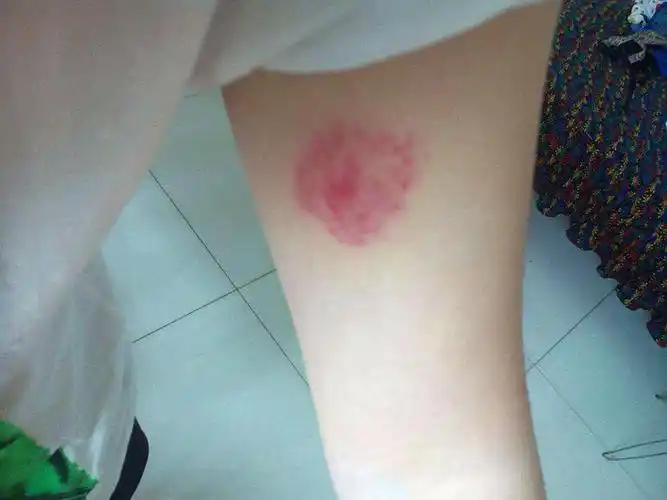 应急处理蜈蚣咬伤后立即用肥皂水清洗伤口,局部应用冷湿敷伤口,亦可用