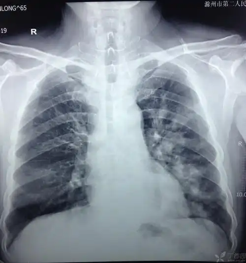 【病例讨论】重症肺部感染一例 [病例帖]